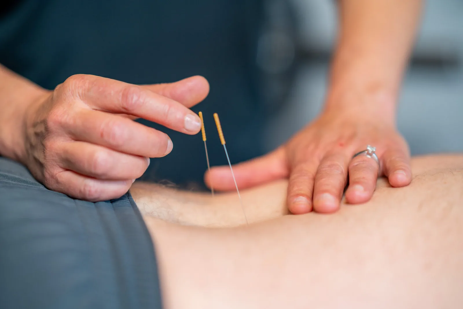 A licensed physical therapist placing dry needles into a patient's lower back